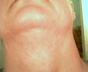 neck rash caused by bedbug bites