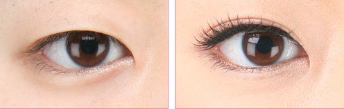 Double-eyelid Surgery: Before and After