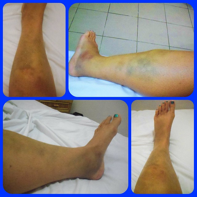 All 103+ Images hematoma in the leg pictures Stunning