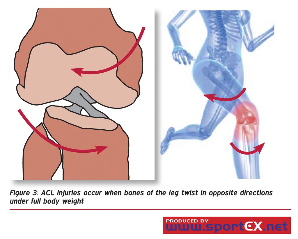 ACL injuries occur when bones of the leg twist in opposite directions under full body weight