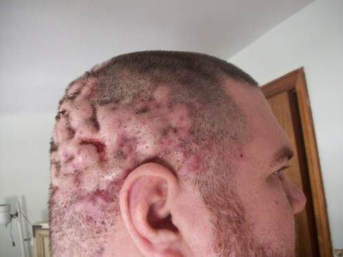 howies download photos form cam 203 - Copy by Dissecting cellulitis of the scalp