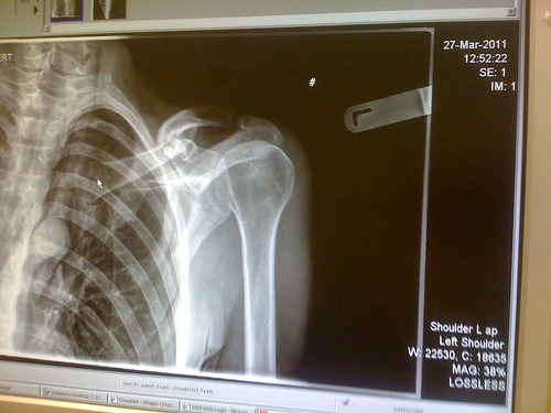 An x-ray can show a broken collar sustained in an accident that was not your fault