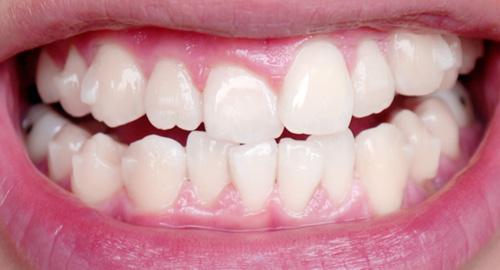 typicalben teeth 1st set of invisalign