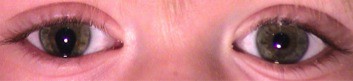 Coloboma de iris en el ojo derecho: se observa que falta el iris de la zona inferior lo que produce una deformación de la pupila que adopta forma de gota invertida
