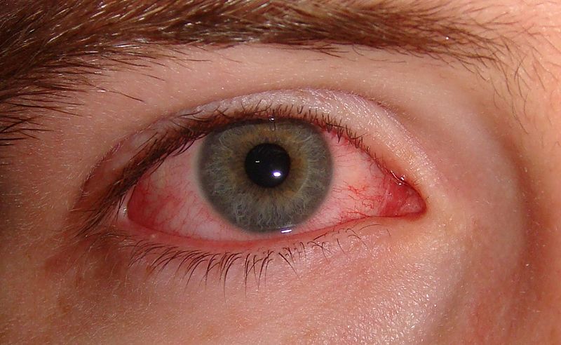 red-irritated-eye