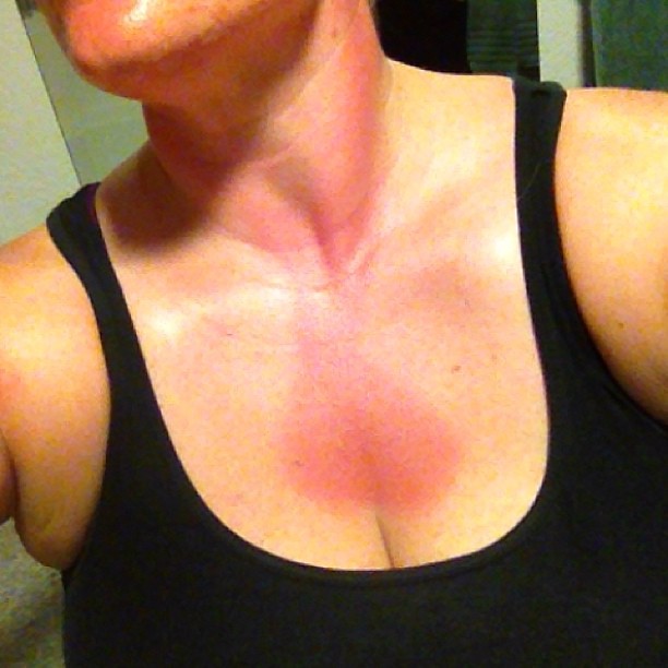 Today I managed to get a testicle shaped sunburn in my chest. AND HOW WAS YOUR DAY?????