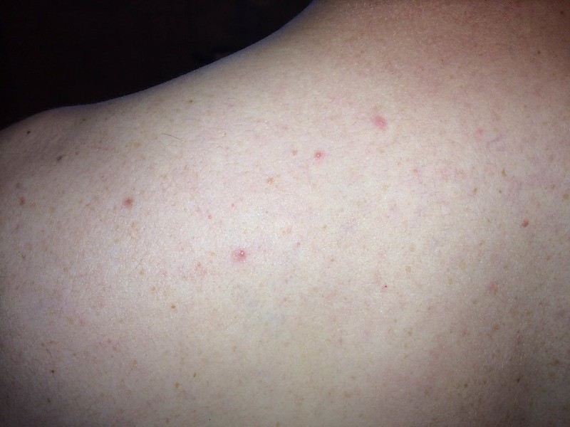 ID BUG CASINGS (and red marks) [a: recent photos= no bed bug evidence ...