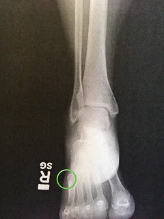 X-ray of fractured metatarsal