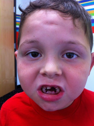 Zach After Having Two Teeth Pulled