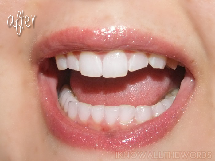 Smile Brilliant LED Tooth Whitening - After