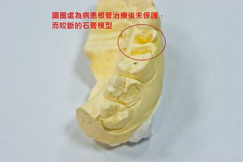 保留剩餘齒質免拔牙－台中豐美牙醫診所之3D齒雕