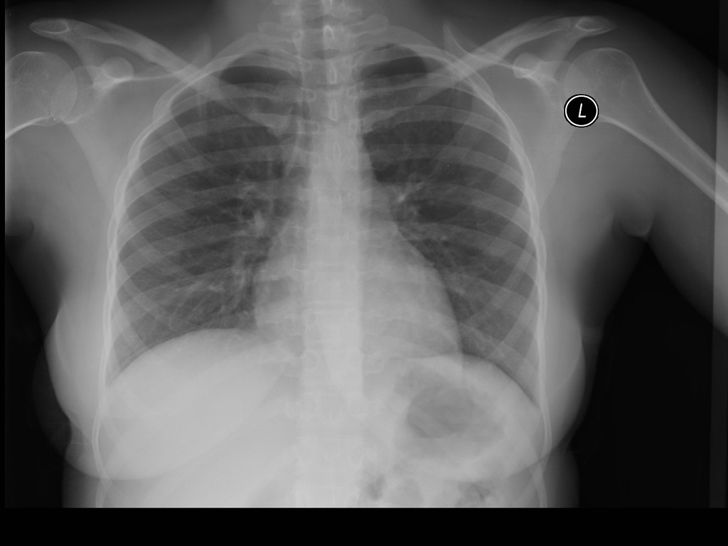 Normal PA chest x-ray