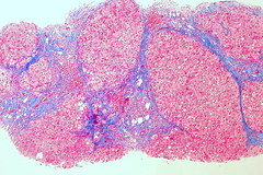 Cirrhosis of the liver (trichrome stain)