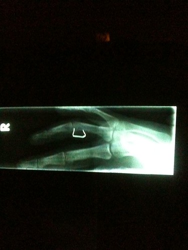 ouch er finger injury xray ow staple