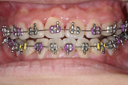 把握兒童牙齒矯正黃金時期 嚮戽鬥說掰掰－黃經理牙醫診所