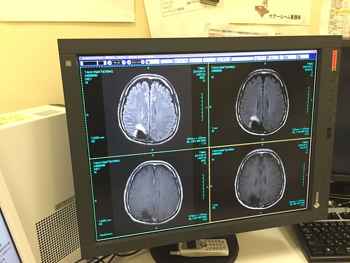 本日の脳のMRI検査の結果