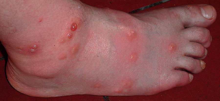mosquito bite allergenic reaction