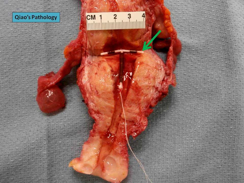Qiao U0026 39 S Pathology  Uterus With A Copper Iud