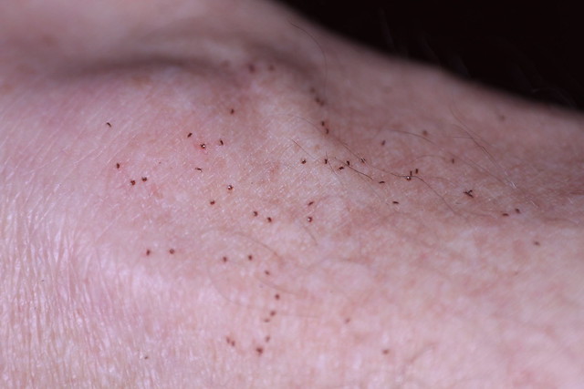 Tiny Bed Bugs on Skin | Flickr - Photo Sharing!