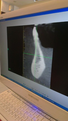 豐美牙醫診所 PRF 3D斷層植牙 (4)