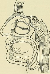 Nasal polyps, Image from page 581 of A manual of modern surgery …