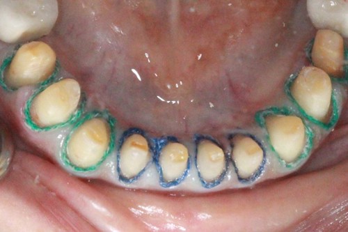 台中黃經理牙醫診所-氧化鋯全瓷冠假牙植牙重建 (8)