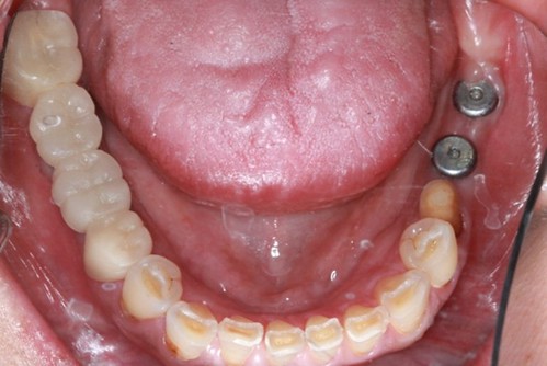 台中黃經理牙醫診所-氧化鋯全瓷冠假牙植牙重建 (3)