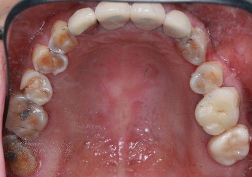 台中黃經理牙醫診所-氧化鋯全瓷冠假牙植牙重建 (2)