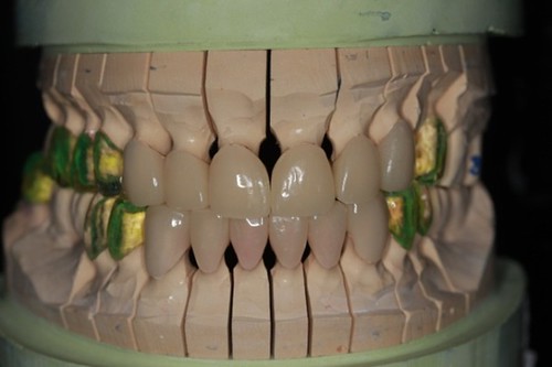 台中黃經理牙醫診所-氧化鋯全瓷冠假牙植牙重建 (9)