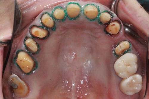 台中黃經理牙醫診所-氧化鋯全瓷冠假牙植牙重建 (7)