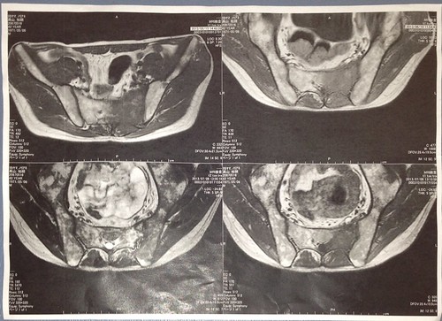 悪性リンパ腫（仙骨部）のMRI画像。抗がん剤治療Hyper-CVAD/MA療法の2コース目終了後。