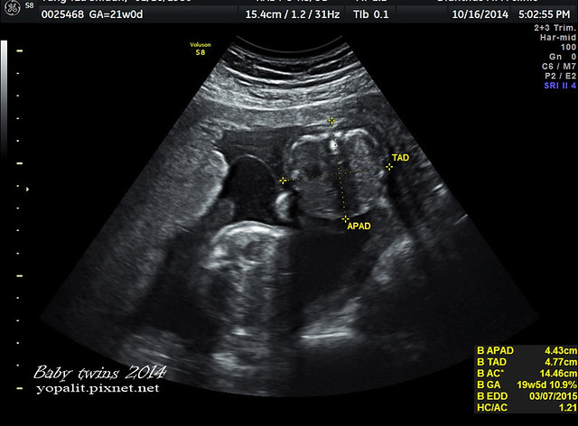 雙胞胎子宮成長日記233