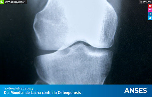 20 de octubre. Día Mundial de Lucha contra la Osteoporosis