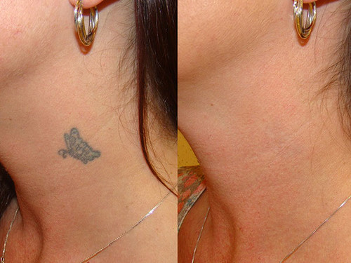 Joel Schlessinger MD explains stacked tattoo removal