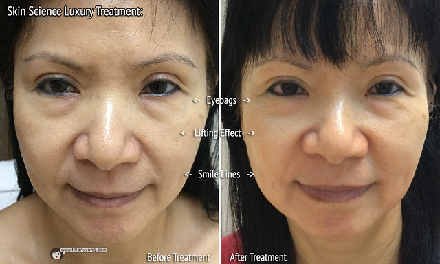 Skin Science Luxury Treatment Before After