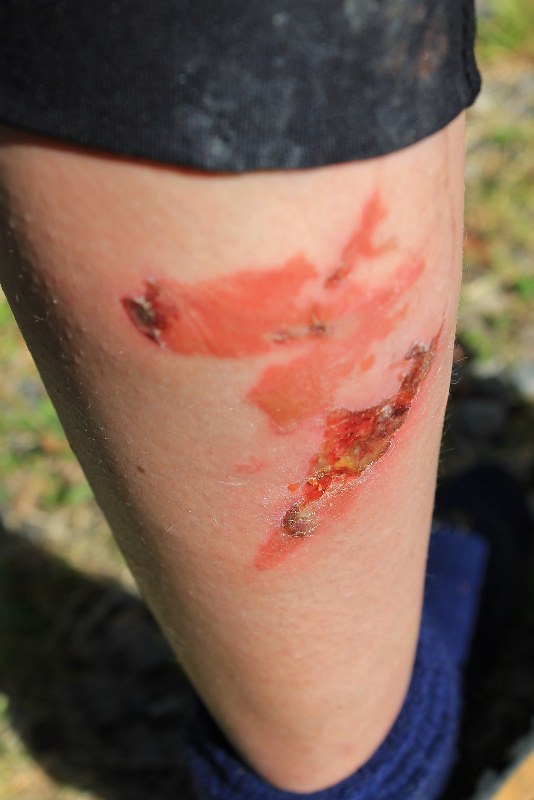 What happens when you use your leg to catch the pan of boiling water that's falling off your camp stove
