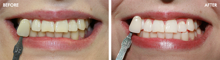 vitality dental teeth whitening edinburgh 1