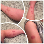 A selection of my bruises one day!