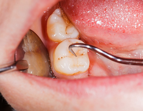 Treatment for a Dental Abscess